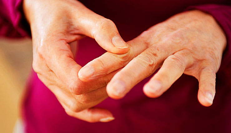 lupus,home remedies,home remedies for lupus,Health tips,fitness tips