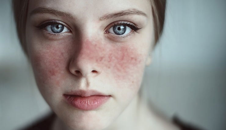 5 Adjunct Home Treatment for Lupus