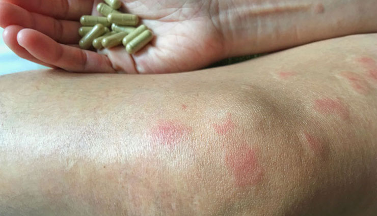 lupus,home remedies,home remedies for lupus,Health tips,fitness tips