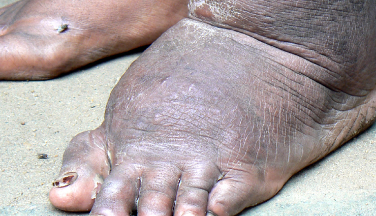 कई खतरनाक बीमारियों का कारण बनते हैं मच्छर, शुरू कर दीजिए सावधानी बरतना mosquito-borne diseases and precautions,protecting against mosquito-borne illnesses,dangers of mosquitoes and disease prevention,mosquito-borne infections and preventive measures,preventing diseases transmitted by mosquitoes,mosquito-borne illness prevention tips,importance of mosquito precautions for health,mosquito-borne diseases and proactive measures,safeguarding against mosquito-borne viruses,taking precautions against mosquito-related diseases