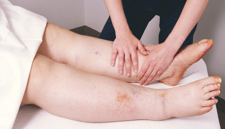 what is elephantiasis,elephantiasis treatment,lymphatic filariasis,elephantiasis symptoms,causes of elephantiasis,how to treat elephantiasis,elephantiasis diagnosis,elephantiasis medications,antiparasitic drugs for elephantiasis,managing elephantiasis symptoms,elephantiasis prevention,elephantiasis mosquito control,diethylcarbamazine for elephantiasis,ivermectin treatment elephantiasis,albendazole for elephantiasis,lymphedema management in elephantiasis,hygiene for elephantiasis,surgical interventions for elephantiasis,elephantiasis skin care,secondary infections in elephantiasis,elephantiasis public health impact,who elephantiasis initiatives,elephantiasis in tropical regions,elephantiasis support groups,education on elephantiasis,elephantiasis global burden,symptoms of lymphatic filariasis,treating lymphatic filariasis,microfilariae detection,prevention of lymphatic filariasis