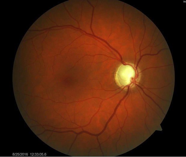 macular edema,symptoms of macular edema,causes of macular edema