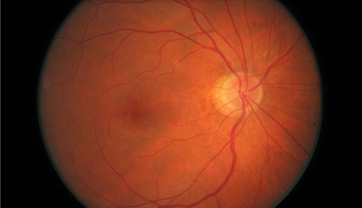 घातक है आँखों की बीमारी मैकुलर इडिमा, जाने लक्षण और उपचार