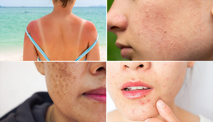 4 Most Common Skin Problems and Their Home Remedies
