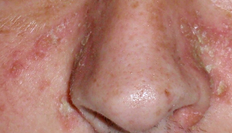 fungal acne explanation,understanding fungal acne,causes of fungal acne,symptoms of fungal acne,fungal acne treatments,fungal acne overview,fungal acne causes and remedies,how to treat fungal acne,fungal acne skin issues,fungal acne management