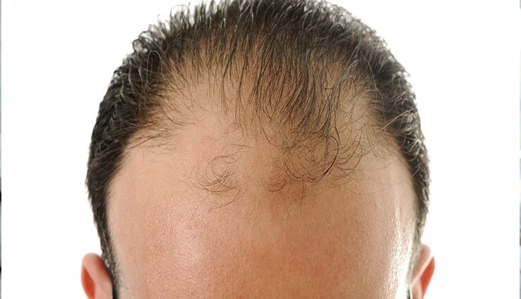 clogged arteries,symptoms of clogged arteries,arteries,angina,chest pain,shortness of breath,erectile dysfunction,male pattern baldness,earlobe crease,Health,Health tips