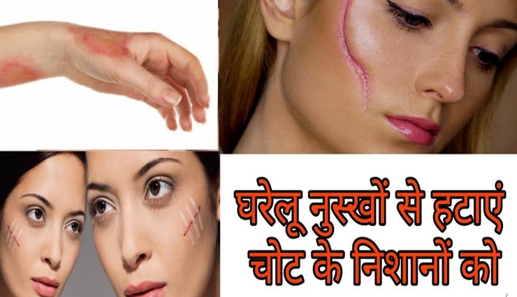 क्या आपके चहरे पर भी हैं पुरानी चोट के निशान, इन घरेलू नुस्खों से दूर होगी यह समस्या