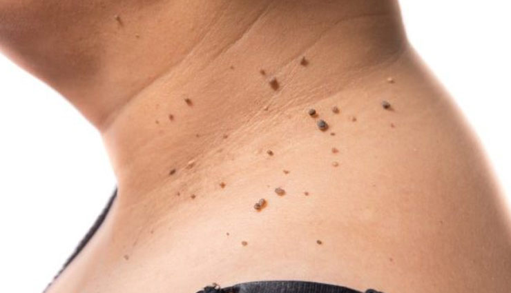 आपकी ख़ूबसूरती को कम करने वाले मस्सो को दूर करे इन घरेलू नुस्खो से 