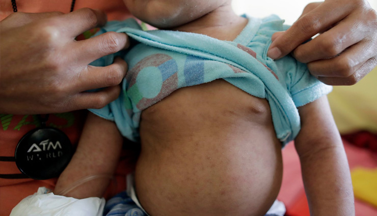 मुंबई में तेजी से फैल रहा खसरा, जानें क्या हैं लक्षण और कैसे होगा बचाव? measles,mumbai measles,khasra,khasra treatment,khasra symptoms,khasra causes,measles causes,health news in hindi