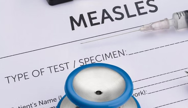 measles,mumbai measles,khasra,khasra treatment,khasra symptoms,khasra causes,measles causes,health news in hindi