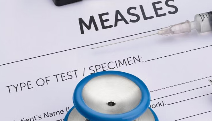 मुंबई में तेजी से फैल रहा खसरा, जानें क्या हैं लक्षण और कैसे होगा बचाव? measles,mumbai measles,khasra,khasra treatment,khasra symptoms,khasra causes,measles causes,health news in hindi