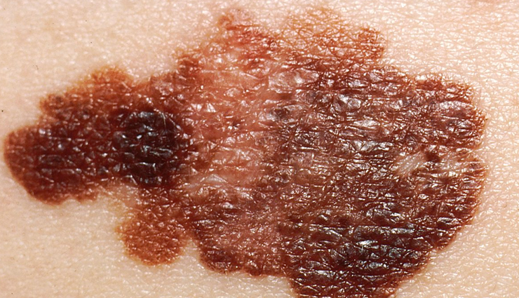 skin cancer symptoms,skin cancer types,skin cancer on face,skin cancer treatment,skin cancer on nose,skin cancer black skin,skin cancer by race,vitamin b skin cancer benefits,skin cancer color,skin cancer center,skin cancer cream,skin cancer color ribbon,vitamin c skin cancer treatment,vitamin c skin cancer prevention,skin cancer diagnosis,skin cancer detection,vitamin d skin cancer,vitamin d skin cancer treatment