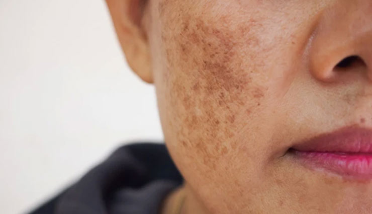 melasma,ways to get rid of melasma,Health tips,fitness tips