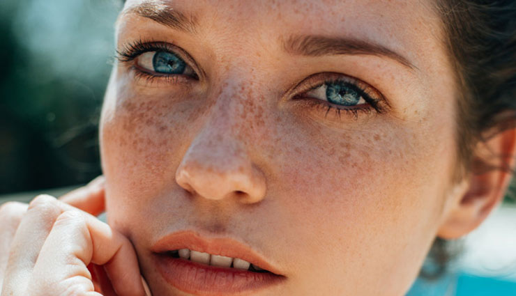 5 Easy Ways To Get Rid of Melasma