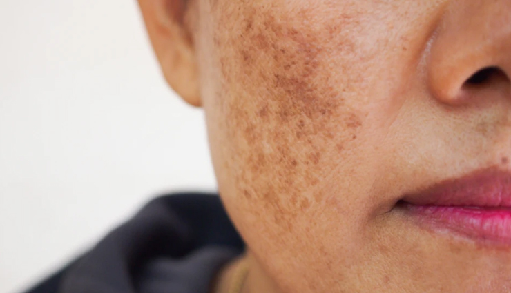5 Ways To Treat Melasma at Home