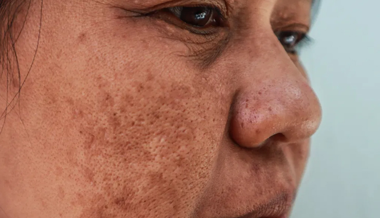 12 Home Remedies To Make Age Spots Less Noticeable
