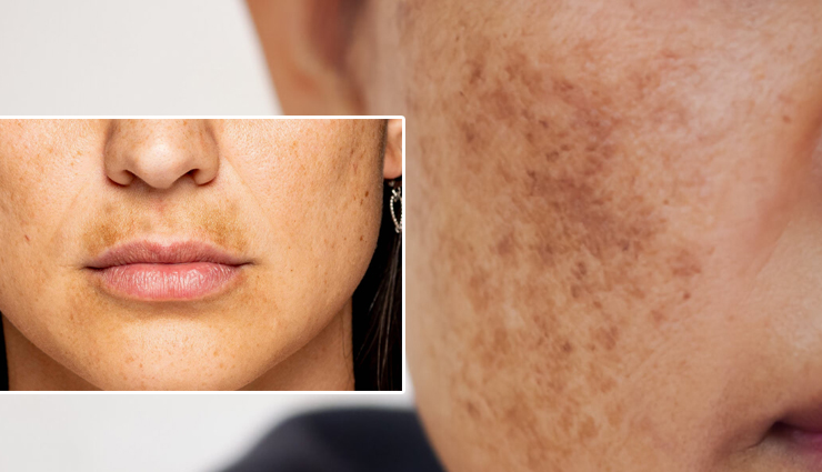8 Effective Home Remedies to Get Rid of Melasma