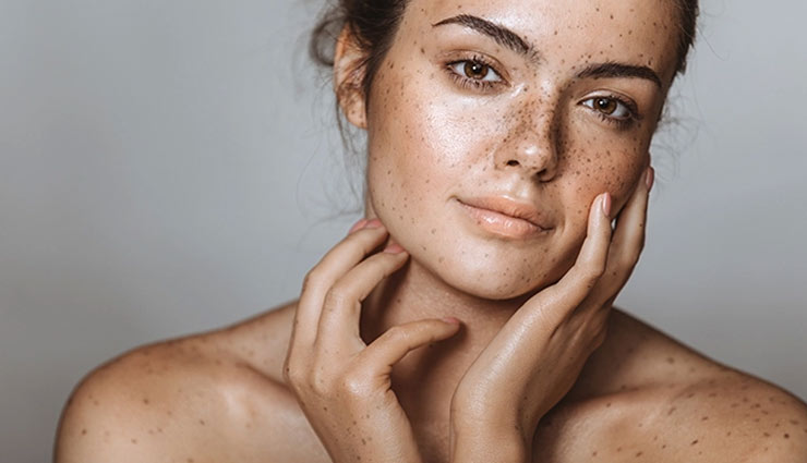 melasma,ways to get rid of melasma,Health tips,fitness tips