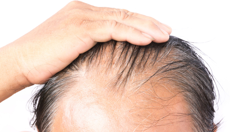 6 Treatments To Treat Hair Loss in Men