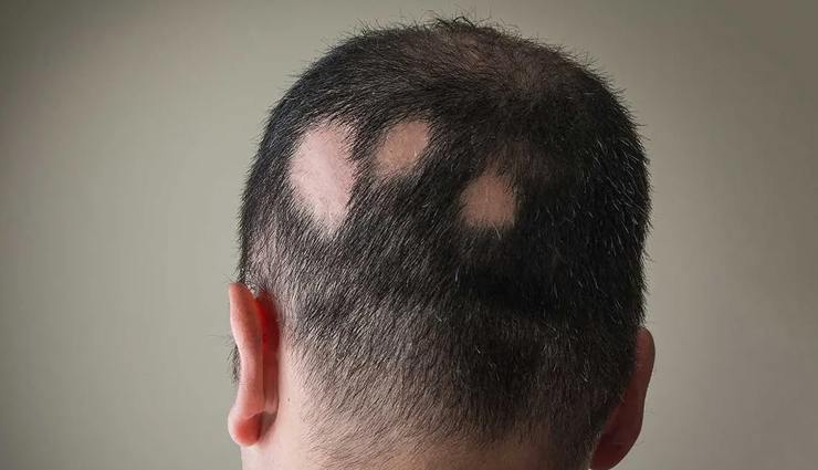 male pattern baldness,alopecia areata,seborrheic eczema,psoriasis,head lice,dandruff,ring worm,folliculitis,scalp conditions that affect men,men hair care tips,hair care tips,beauty tips,scalp care tips