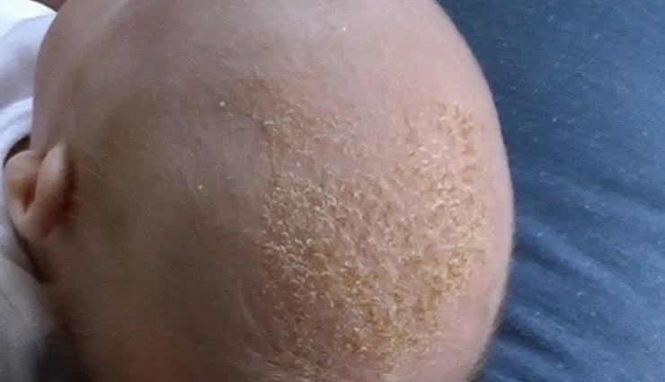 male pattern baldness,alopecia areata,seborrheic eczema,psoriasis,head lice,dandruff,ring worm,folliculitis,scalp conditions that affect men,men hair care tips,hair care tips,beauty tips,scalp care tips