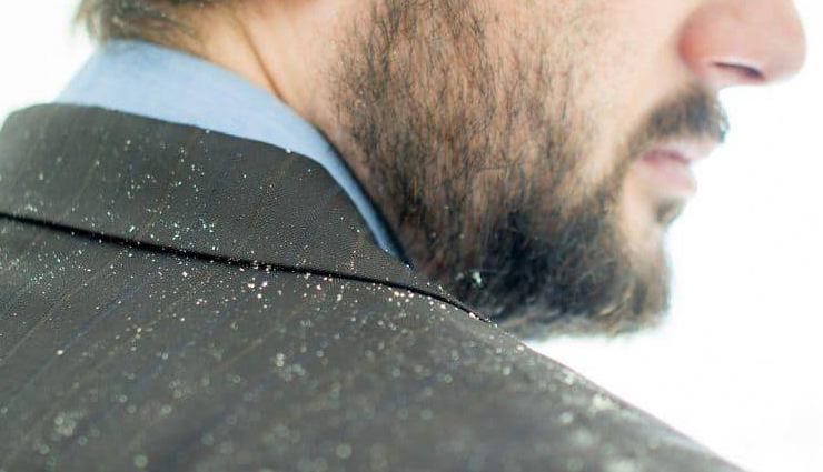 male pattern baldness,alopecia areata,seborrheic eczema,psoriasis,head lice,dandruff,ring worm,folliculitis,scalp conditions that affect men,men hair care tips,hair care tips,beauty tips,scalp care tips