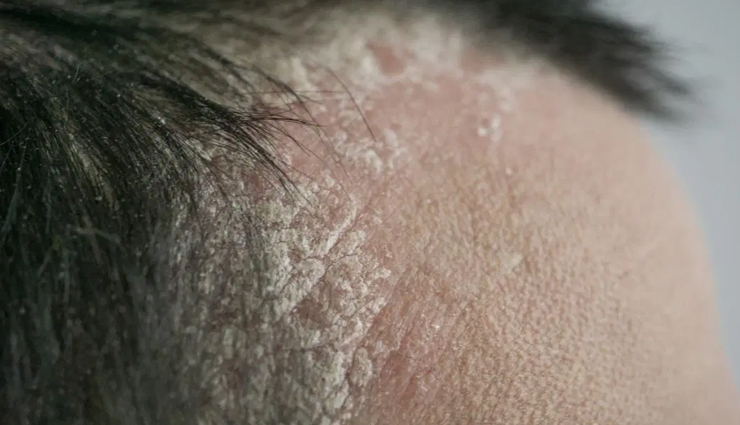 male pattern baldness,alopecia areata,seborrheic eczema,psoriasis,head lice,dandruff,ring worm,folliculitis,scalp conditions that affect men,men hair care tips,hair care tips,beauty tips,scalp care tips