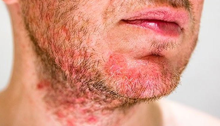 male pattern baldness,alopecia areata,seborrheic eczema,psoriasis,head lice,dandruff,ring worm,folliculitis,scalp conditions that affect men,men hair care tips,hair care tips,beauty tips,scalp care tips