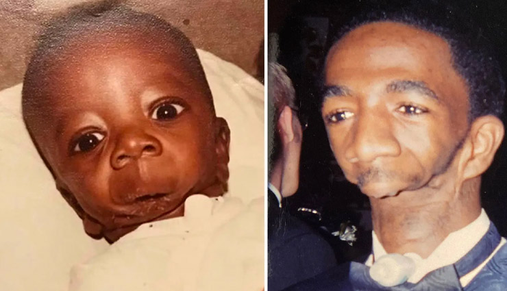 बिना जबड़े का है ये शख्स, ना बोल पाता, ना कभी टेस्ट किया खाना, बताया कैसे मिली दुल्हन men without jaw,weird news