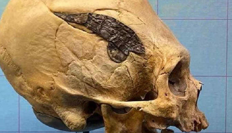 एडवांस तरीके से सर्जरी कर 2000 साल पहले खोपड़ी में लगाया गया था मेटल