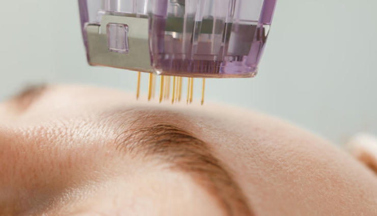 pitted acne scars remedies,treating pitted acne scars,get rid of pitted acne scars naturally,effective remedies for pitted acne scars,home treatments for pitted acne scars,how to reduce pitted acne scars,must-try solutions for pitted acne scars,pitted acne scars removal tips,natural ways to heal pitted acne scars,managing pitted acne scars with remedies,pitted acne scar treatment at home,remedies for smoothing pitted acne scars,best practices to diminish pitted acne scars,reducing the appearance of pitted acne scars,homecare for pitted acne scar issues,tips to fade pitted acne scars,natural remedies for pitted acne scars,pitted acne scars self-care,pitted acne scars recovery with remedies,must-do remedies for pitted acne scar improvement