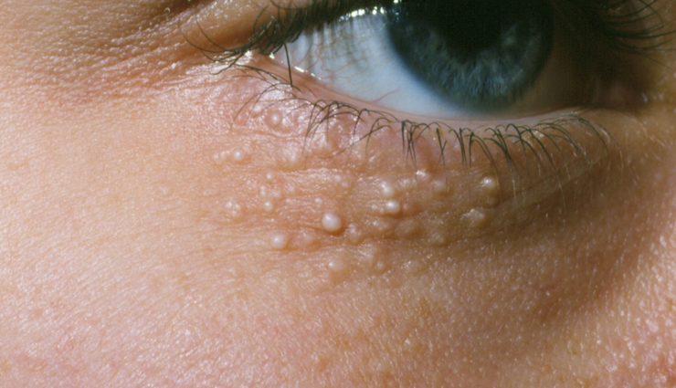 10 Home Remedies For Milia To Prevent It