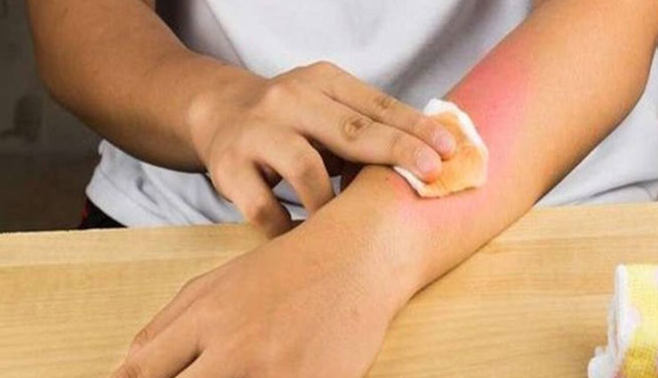 minor burns,home remedies for minor burns,Health tips,fitness tips