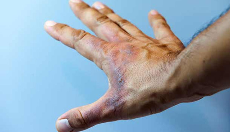 5 Home Remedies To Treat Minor Burns