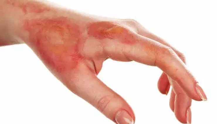 minor burns,home remedies for minor burns,Health tips,fitness tips