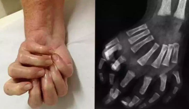 Diagnosis and Treatment for Mirror Hand Syndrome