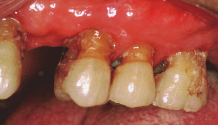 old-age dental problems,common dental issues for seniors,dry mouth solutions for elderly,missing teeth remedies,gum disease prevention for seniors,fungal infections in elderly,oral care tips for older adults,managing dental health in seniors,geriatric dental care tips,dental health for elderly