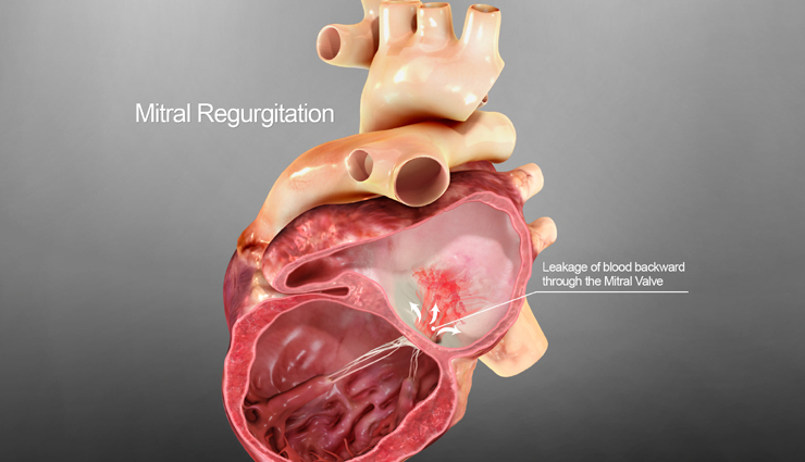 heart diseases,different type of heart diseases,heart care tips,heart care,heart condition,illness of heart,Health,Health tips