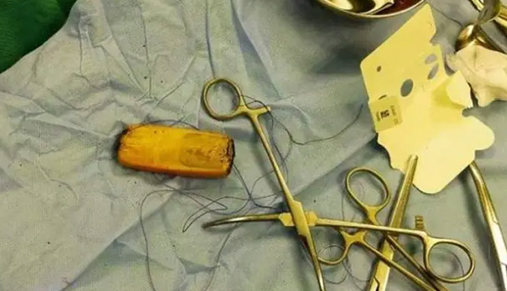 डॉक्टरों ने शख्स के पेट से निकाला मोबाइल, पीछे छह महीने से था दर्द