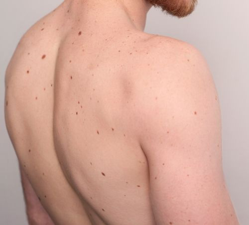 moles,moles indication,moles on female body,mole on male body