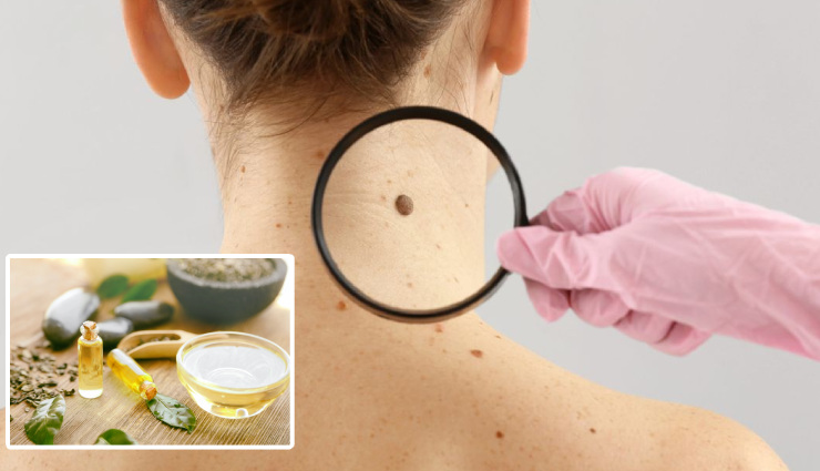 6 Amazing Benefits of Using Tea Tree Oil for Moles