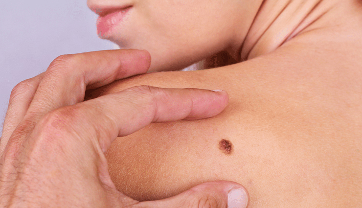 home treatments for removing moles,removing moles,tips to remove moles,dos and donts for moles,beauty tips,beauty hacks