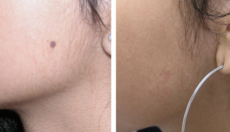 चेहरे के तिल जो ख़ूबसूरती घटाए, उन्हें दूर करें इन तरीकों से