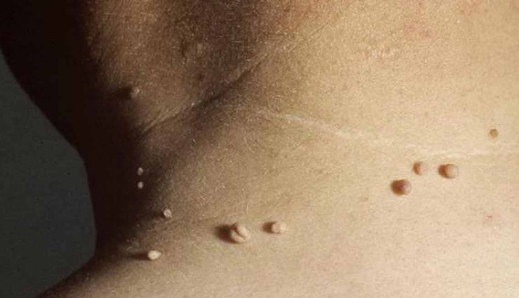 beauty tips,home remedies,moles,moles remove,beauty tips,beautiful face