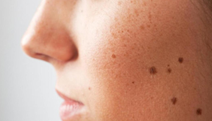 9 Things To Keep in Mind For Moles