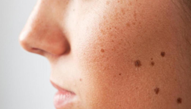 6 Home Remedies To Treat Skin Moles