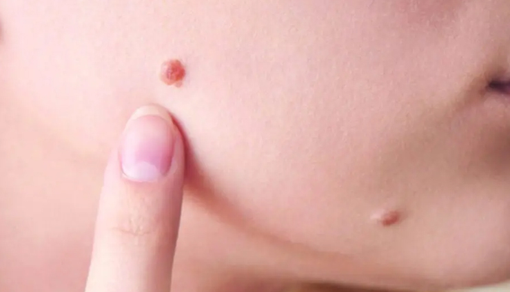 6 Ways You Can Get Rid of Moles Naturally