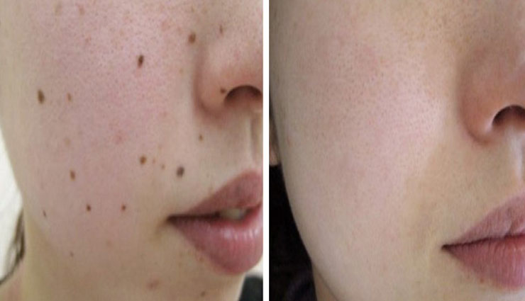 beauty tips,moles remove tips,face beauty tips,tips