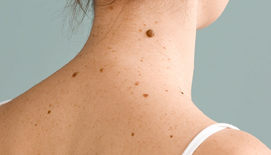 शरीर पर अचानक क्यों उभरने लगते हैं कई तिल? जानिए इसके पीछे की वजहें