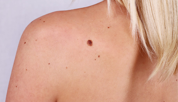 Tips To Use Castor Oil To Get Rid Of Moles